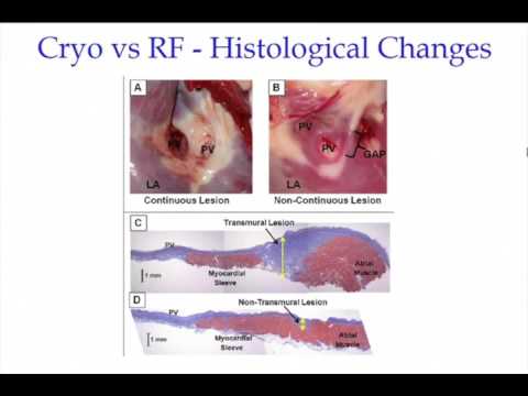 Dott. Saverio Iacopino - Terapia ablativa: Cryo o radiofrequenza
