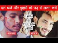 How to Remove Dark Spot and Pimples | Get Fair & Clear Skin - SAHIL