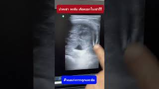 ปวดเข่า หกล้ม เลือดออกในเข่า #หมอเก่งกระดูกและข้อ #ปวดเข่า #หกล้ม #เลือดออก #เข่าบวม