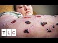 Living with the worlds most painful disease  body bizarre
