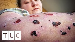 Living With The World’s Most Painful Disease  Body Bizarre