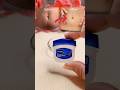 Stretch Marks Removal Cream At Home рџ Ї Viral Stretchmarks Skincare Stretchmarkscream Shorts Stretch Marks Removal Cream At Home рџ Ї Viral Stretchmarks Skincare Stretchmarkscream Shorts