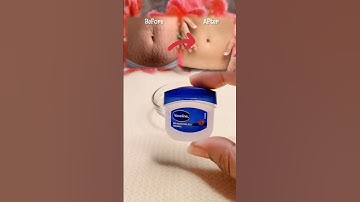 Stretch Marks Removal Cream at Home 💯 #viral #stretchmarks #skincare #stretchmarkscream #shorts