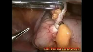 Laparoscopic Appendix Surgery(Appendectomy)