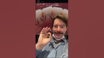 Let’s Talk About Permanent Retainers