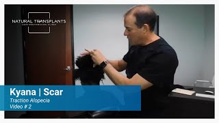 Fine Pencil Line Scar from Hair Transplant: Barely Noticeable! | Dr. Siegel (Kyana)