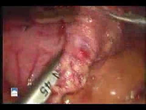 Laparoscopic Duodenal Switch - Dr. Smith