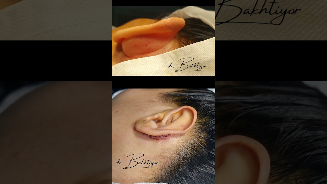 #Otoplasty ☎️+998917895010 #отопластика #пластикалица #пластическаяоперация #ринопластика #quloq