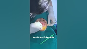 Xử lý răng khôn mọc ngầm, lệch quá nhanh quá nguy hiểm #shorts #nhakhoa #amassdental