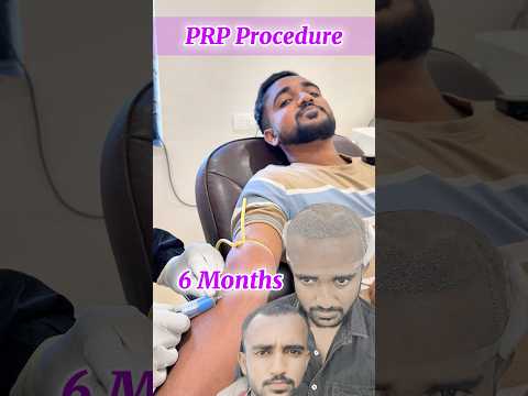 PRP Hair Treatment