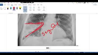 Pulmonary embolism