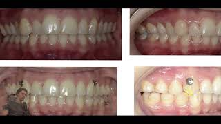 Case study №10, distalization and mandibular advancement | in-house aligners