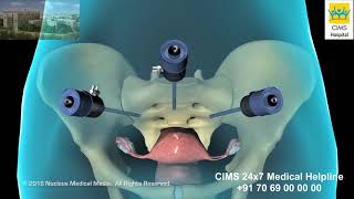 Hysterectomy – CIMS Hospital