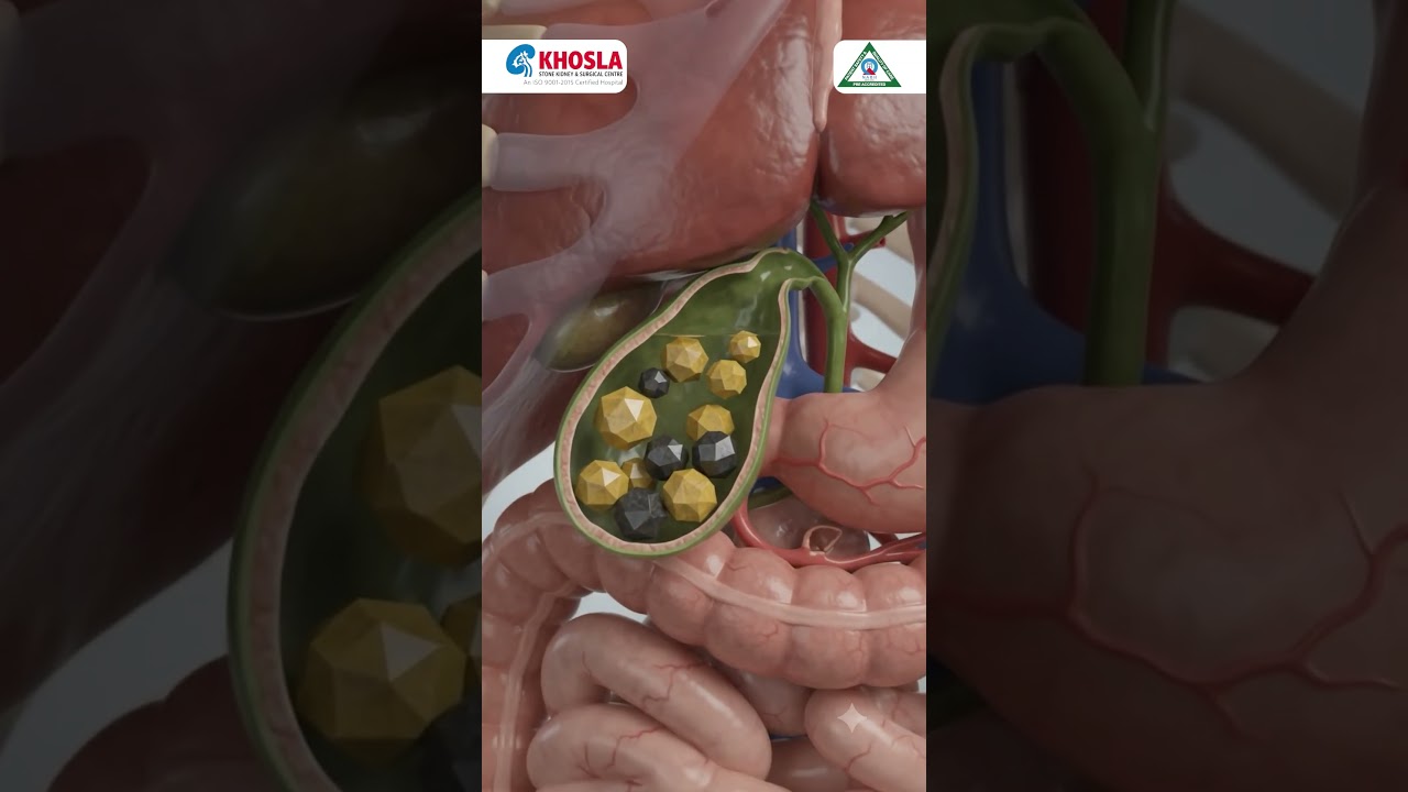 Upper Right Pain After Eating? | Gallstone Treatment Ludhiana | Is It Really Acidity?