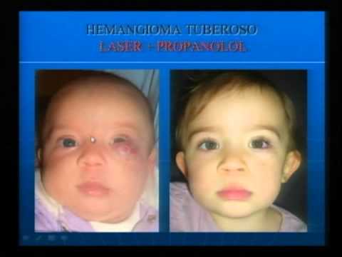 hemangioma plano recem nascido hemangioma plano recem nascido