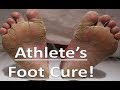 Athlete's Foot Fungus! [BEST Home Remedies]