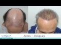 Alopecia grado 7 en paciente de 70 aos