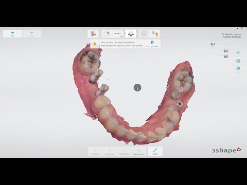 Implant level scans with 3Shape Trios