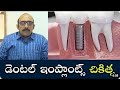 Dental Implant Treatment in Hyderabad | Dental Implant Procedure | Dr. Venkata Ratna Nag