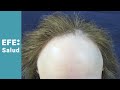 Alopecia frontal fibrosante, angustia de mujer