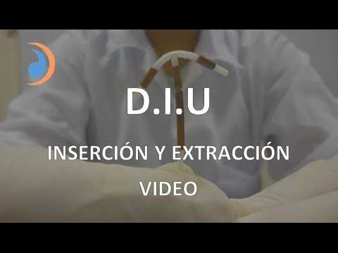 Vídeo: Calambres Después De La Inserción, Extracción Y Más Del DIU