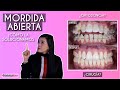Mordida abierta ¿Cómo la solucionamos? #Ortodoncia - Odontología Láser.