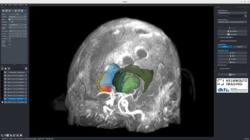 [Napari] Brain structure segmentation in T1 with nnInteractive