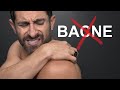 How To ELIMINATE Back Acne!