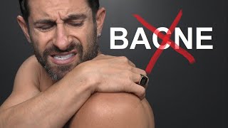 How To Eliminate Back Acne