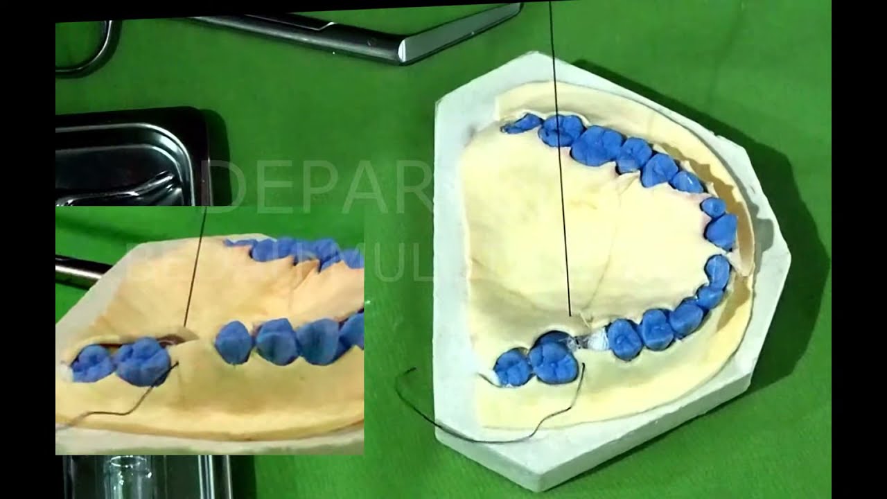 TATALAKSANA OROANTRAL COMMUNICATION