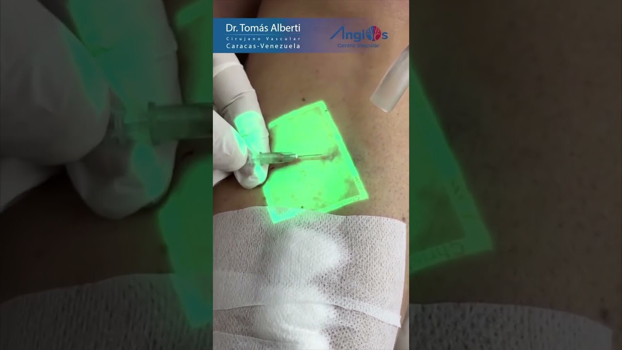 ARAÑAS VASCULARES (Venas de pequeño calibre visibles). Tratamiento