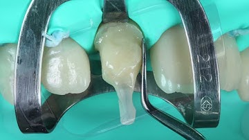 LuxaCore Z by DMG: Precise preparation thanks to dentine-like trimmability.