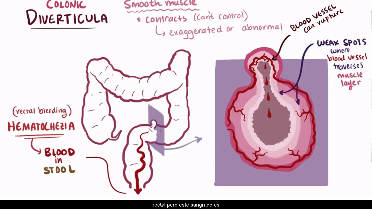Diverticular Disease Pathology Review Video Osmosis