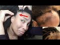 How To Regrow Your Hair and Prevent Hair Loss -  15 Tips Against Traction Alopecia (The First Steps)