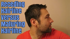 Receding Hairline Versus Maturing Hairline, Is My Hairline Receding, Maturing, or Balding?, Mature Hairline vs Receding Hairline: How is it Distinguished?, Does a Mature Hairline Mean I Will Go Bald Young?, Receding Hairline: Until You See Thinning, Stop Worrying