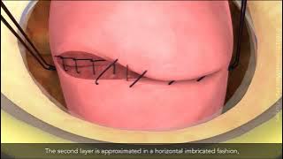 Caesarean section in patients with an elevated BMI