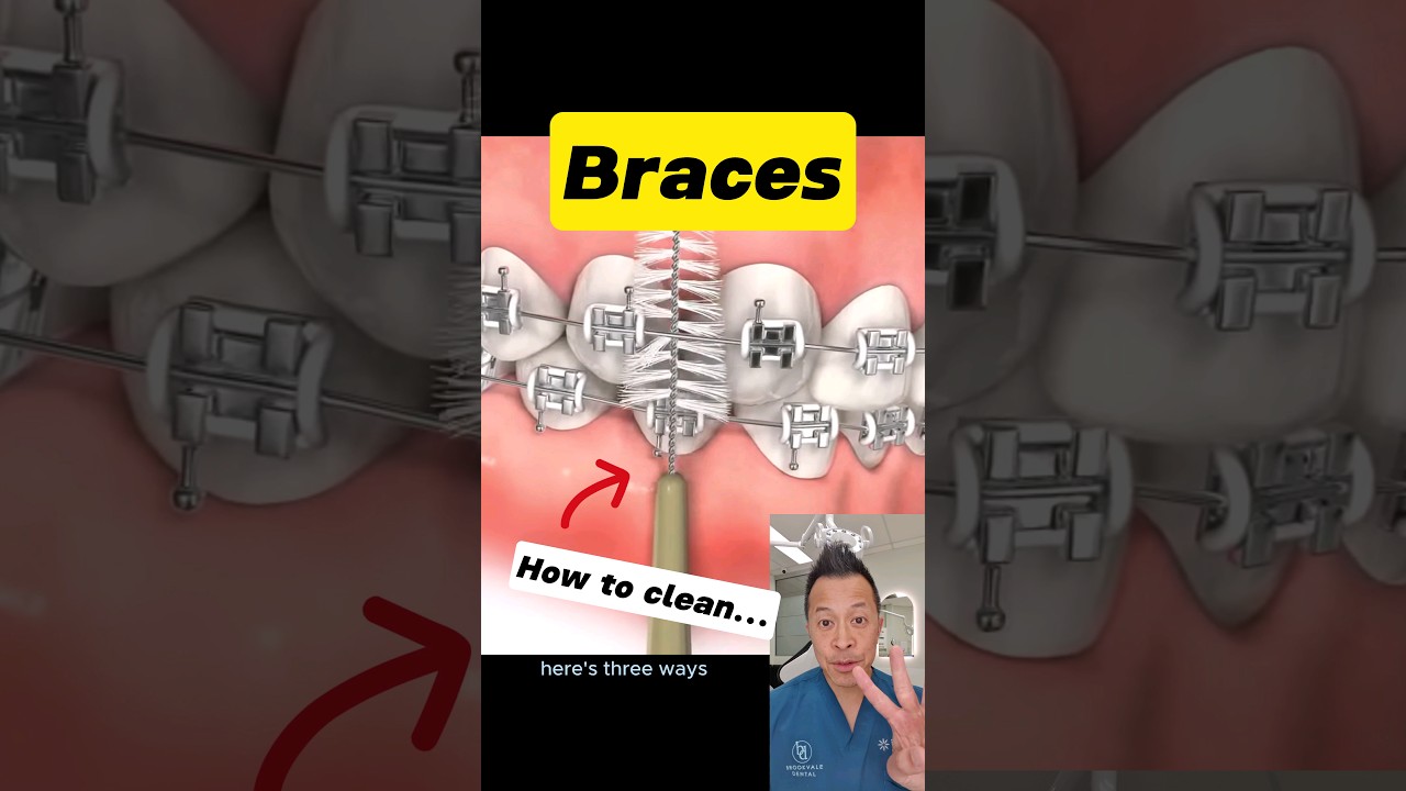 Top Hacks for Cleaning Your Braces at Home 