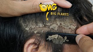 Satisfying Itchy Dry Scalp Big Dandruff Scratching #1209