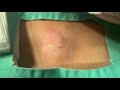 粉瘤くりぬき法 40代女性背中epidermal cyst atheroma cystic acne extractions 脂肪腫lipoma クリニーク大阪心斎橋・大阪梅田・名古屋・福岡・西宮尼崎