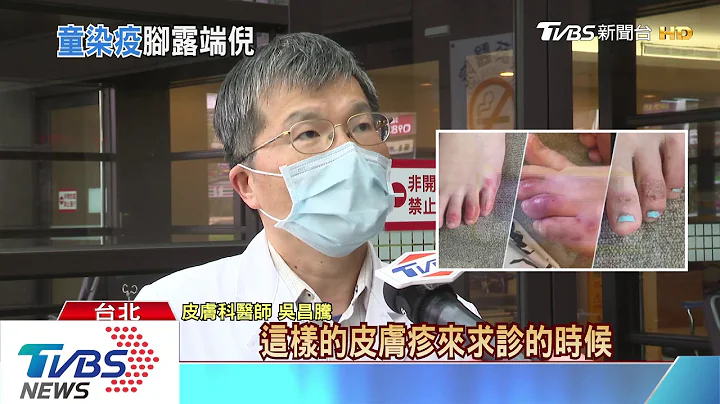 脚趾冻疮、疱疹！美研究“无症状者”确诊征兆 - 天天要闻