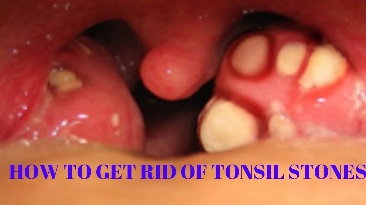 how to get rid of tonsil stones - YouTube