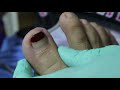 Ep_656 Ingrown nail removal 👣 นั่งเกร็งนาน เพราะกลัวจะเหมือนคลิป 😊 (This video clip from Thailand)