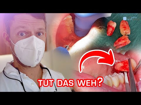 Video: Kann ich alle Weisheitszähne auf einmal entfernen?