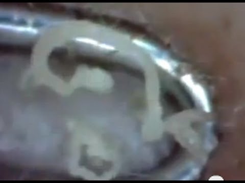 Harlem Shake (Dancing Zit Edition)