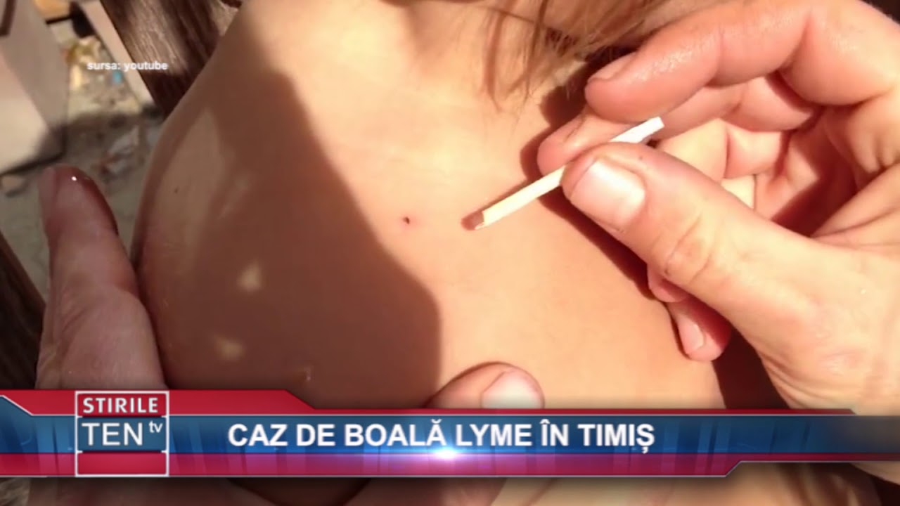 Caz De Boala Lyme In Timis 07 August 2018 Youtube