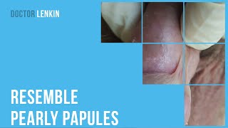 6Th And 59Th Types Of Human Papillomavirus Hpv That Resemble Pearly Papules