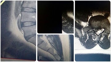 TRANSFORAMINAL PERCUTANEOUS ENDOSCOPIC DISCECTOMY,CHENNAI PAIN CENTRE