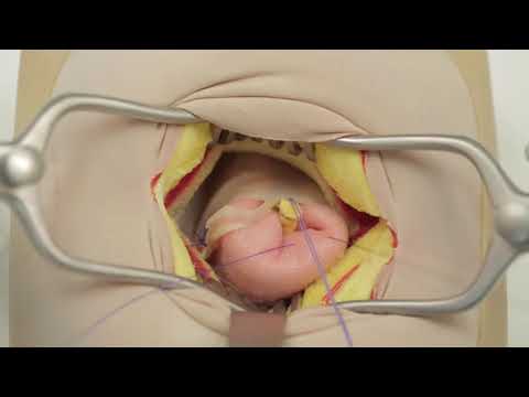 Teknik Apendektomi Terbuka // untuk Residen Bedah Umum Tahun Pertama // Konsep Sederhana