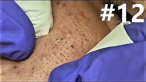 BLACKHEADS EXTRACTIONS on Happy #12