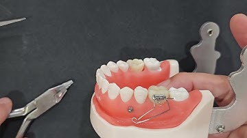 Phân tích cơ học dựng trục và lún răng cối với 1 minivis